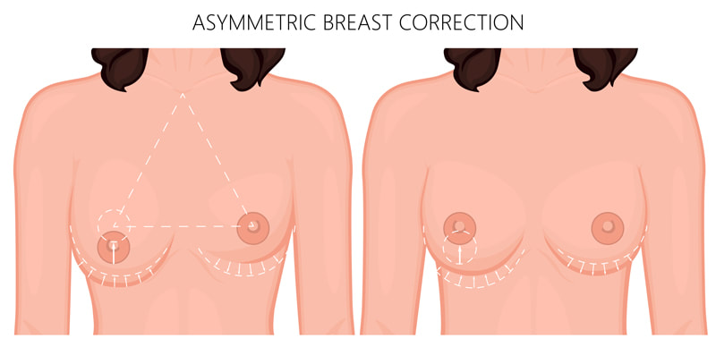 Asymmetrical women breast shape lift nipple silicone surgery