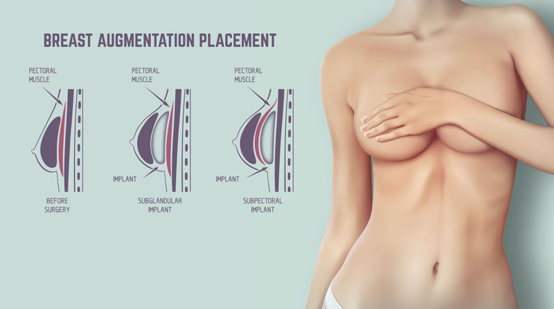 Breast Lift with Implants Surgery