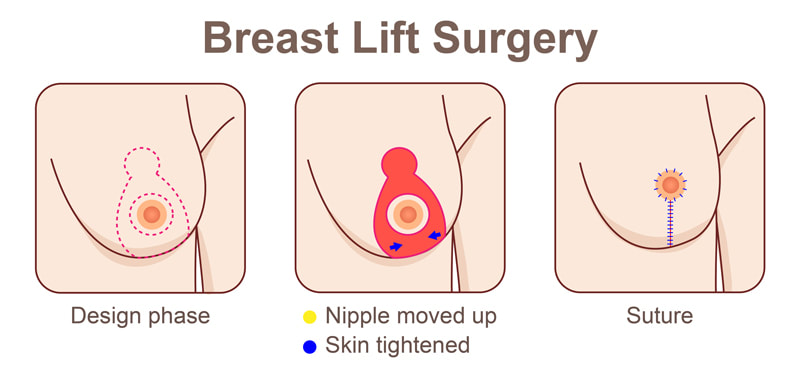 Breast Lift Surgeon in Perth